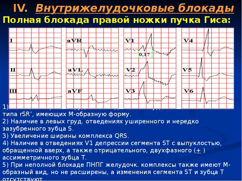 Экг неполная блокада правой. Признаки полной блокады правой ножки пучка Гиса на ЭКГ. Признаки блокады правой ножки пучка Гиса на ЭКГ. ЭКГ при полной блокаде ножек пучка Гиса. Блокада правой ножек пучка Гиса на ЭКГ.