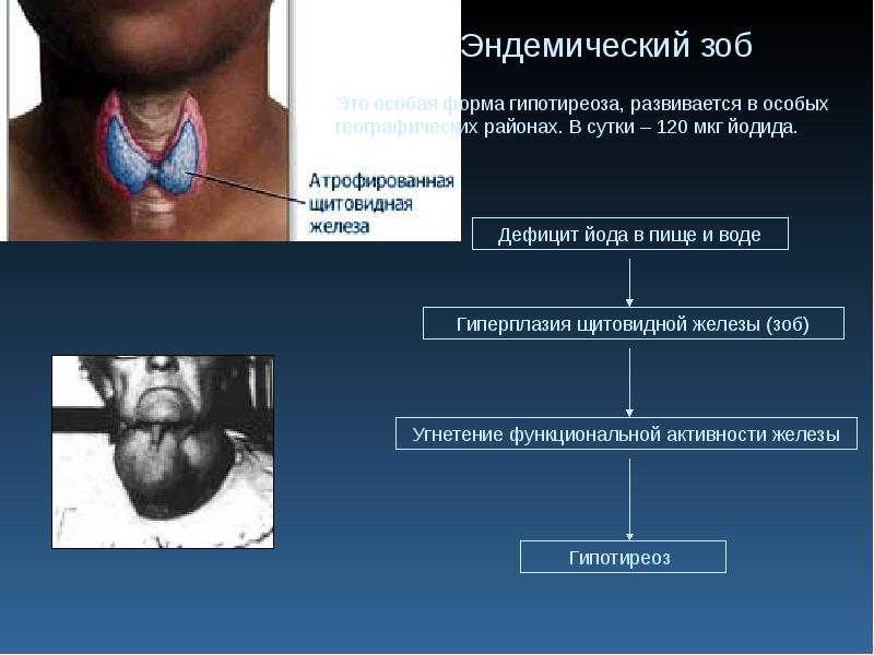 Презентация на тему гипотиреоз