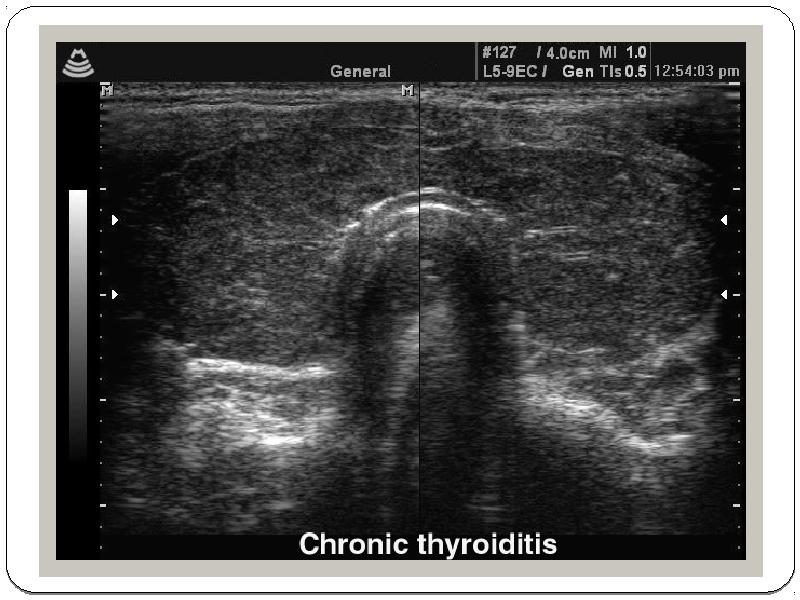 Узи подострый тиреоидит картина