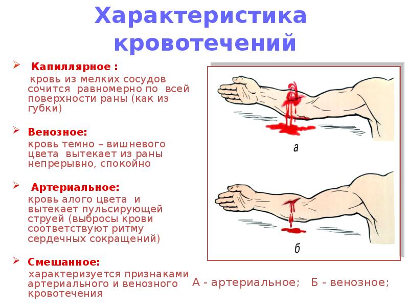 Методы остановки венозного кровотечения тест