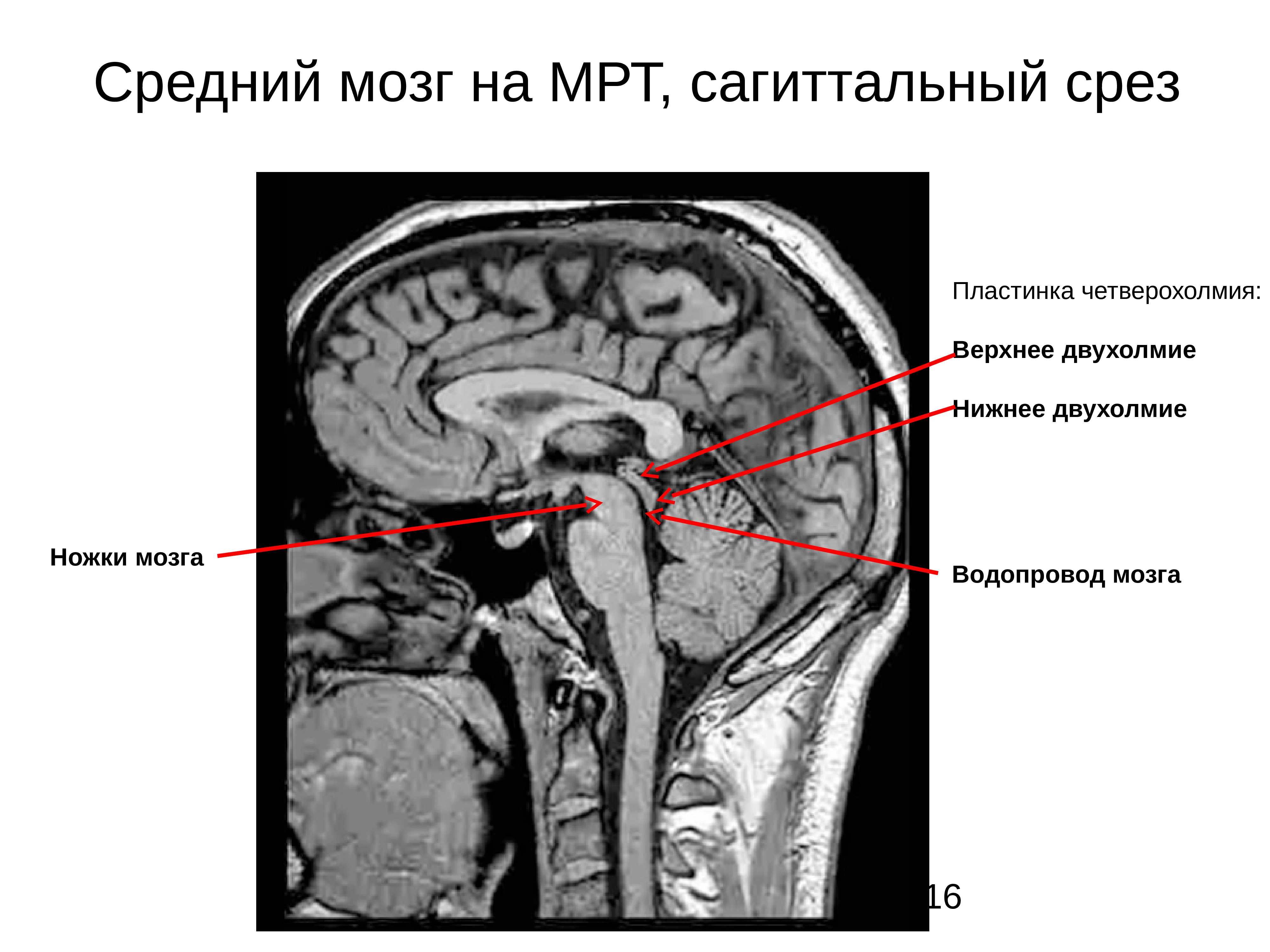 Оболочки мозга мрт