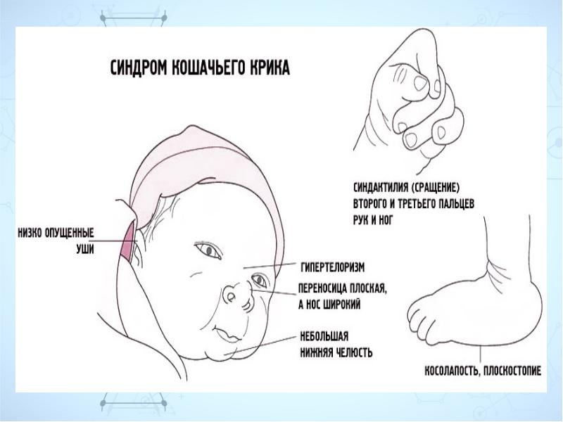 Презентация на тему синдром кошачьего крика