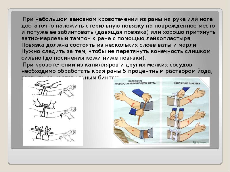 При венозном кровотечении накладывается давящая повязка