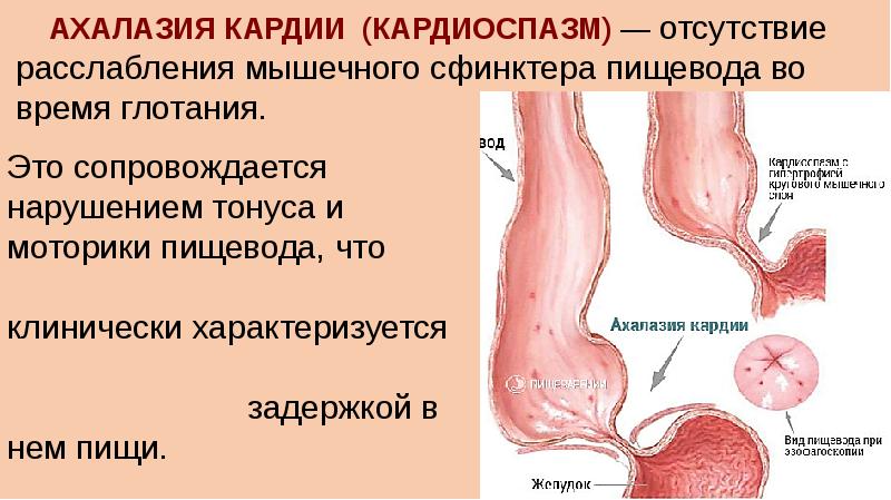 Схема ахалазия кардии