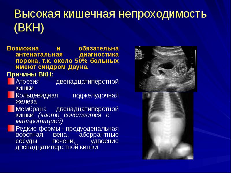 Высокая кишечная непроходимость (ВКН)
Возможна и обязательна антенатальная диагностика порока, т.к. Высокая кишечная непроходимость (ВКН)
Возможна и обязательна антенатальная диагностика порока, т.к.