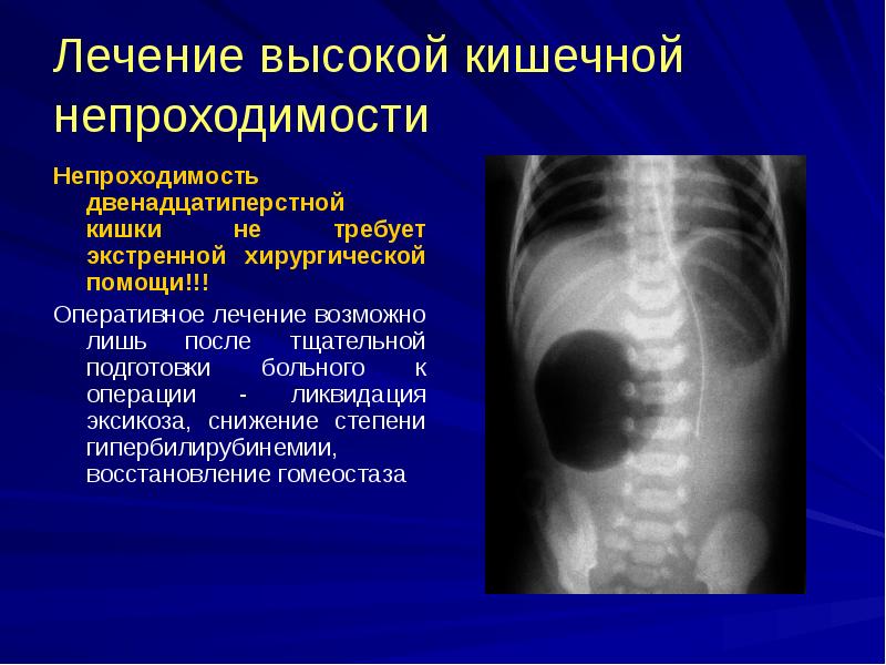 Лечение высокой кишечной непроходимости
Непроходимость двенадцатиперстной кишки не требует экстренной хирургической Лечение высокой кишечной непроходимости
Непроходимость двенадцатиперстной кишки не требует экстренной хирургической