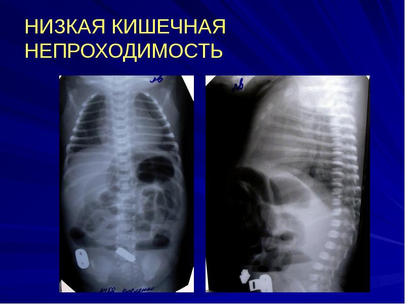 НИЗКАЯ КИШЕЧНАЯ НЕПРОХОДИМОСТЬ НИЗКАЯ КИШЕЧНАЯ НЕПРОХОДИМОСТЬ