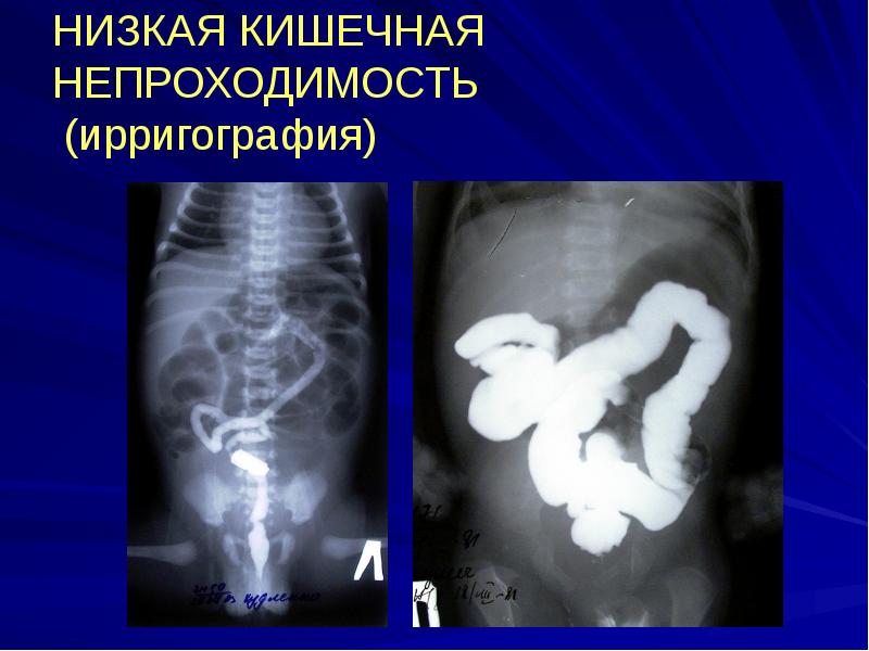 НИЗКАЯ КИШЕЧНАЯ НЕПРОХОДИМОСТЬ (ирригография) НИЗКАЯ КИШЕЧНАЯ НЕПРОХОДИМОСТЬ (ирригография)