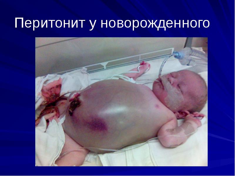 Перитонит у новорожденного Перитонит у новорожденного