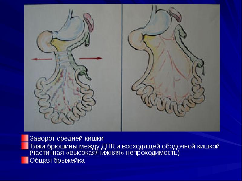 Заворот средней кишки
Заворот средней кишки
Тяжи брюшины между ДПК и Заворот средней кишки
Заворот средней кишки
Тяжи брюшины между ДПК и