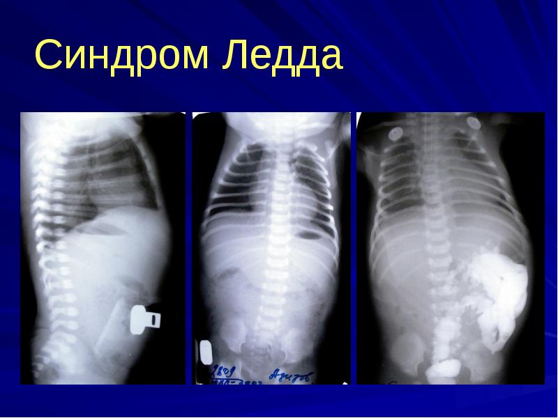 Синдром Ледда Синдром Ледда