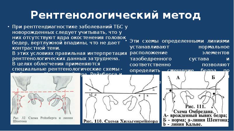 Для клинической картины врожденного вывиха бедра характерны симптомы