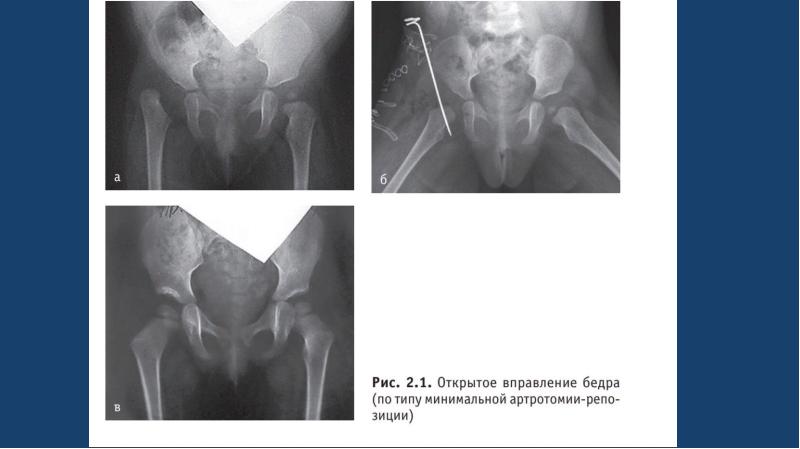 Вывих бедра презентация
