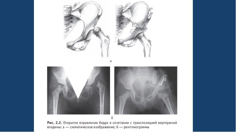 Врожденные вывихи бедра презентация