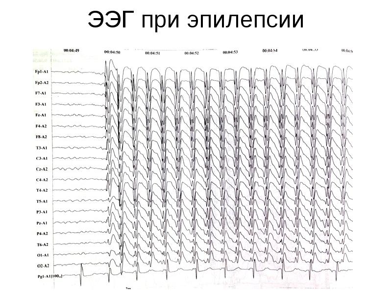 Ээг показывает эпилепсию