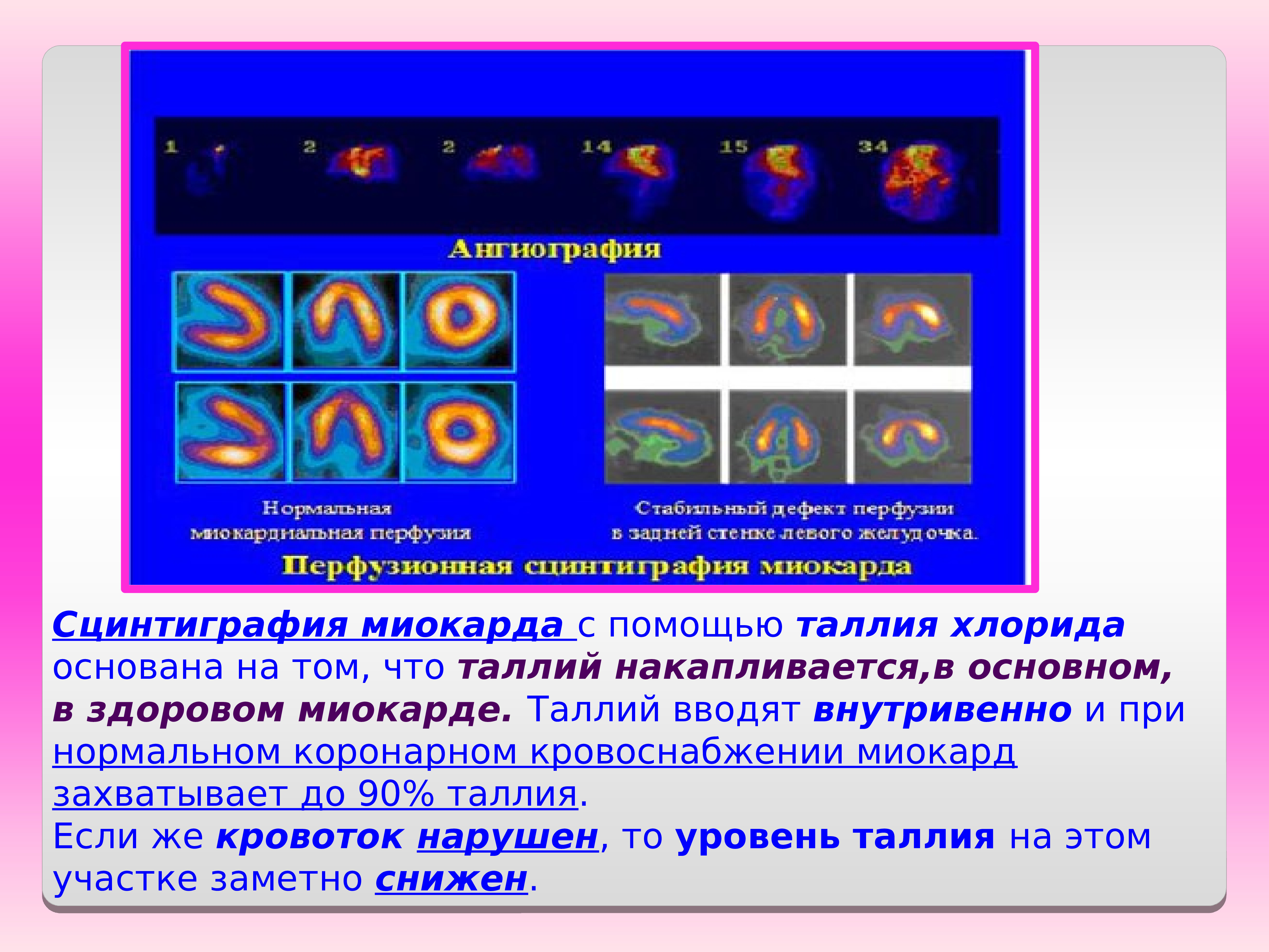 Презентация сцинтиграфия миокарда