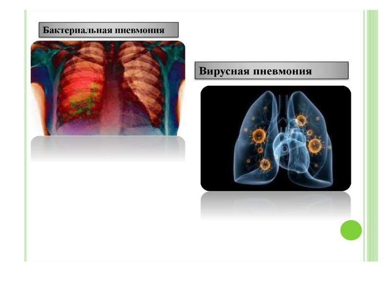 Бактериальная пневмония. Пневмония вызывается бактериями. Бактериальная пневмония и вирусная пневмония. Септическая бактериальная пневмония. Вирусно-бактериальная пневмония кт.