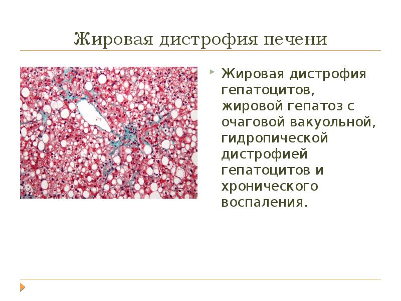 Жировая дистрофия печени