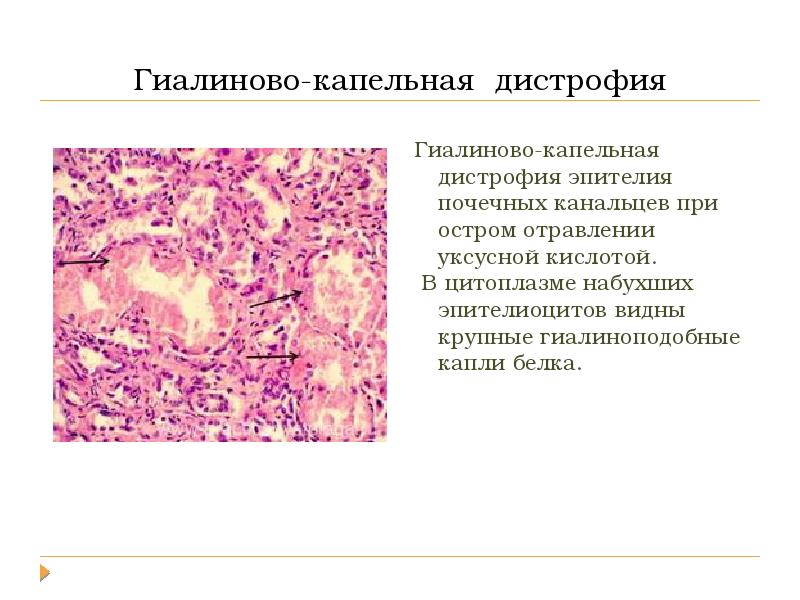 Повреждения дистрофии презентация