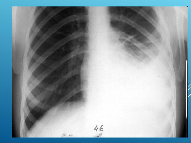 Плеврит легких на рентгене фото