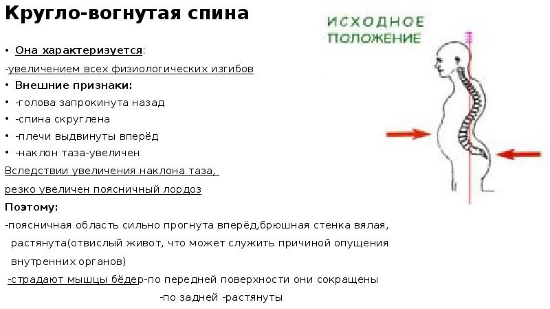 Лордоз сохранен что это значит. Лордоз сохранен что это значит