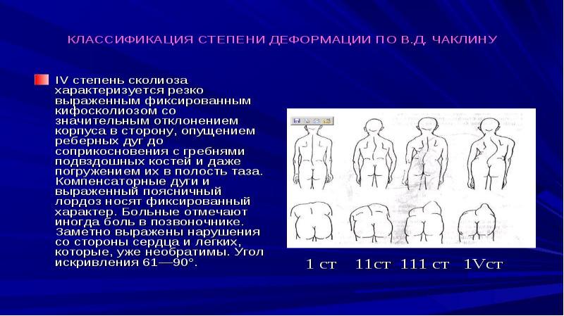 Сколиоз это поправимо проект по физкультуре