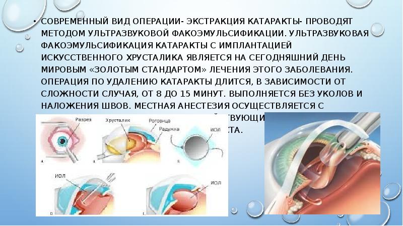 Хирургическое лечение катаракты презентация