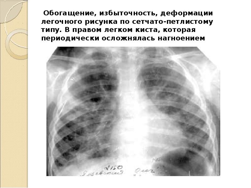 Усилен рисунок в прикорневых зонах. Синдром деформации легочного рисунка. Ячеистая деформация легочного рисунка рентген. Изменение легочного рисунка. Легочный рисунок деформирован.