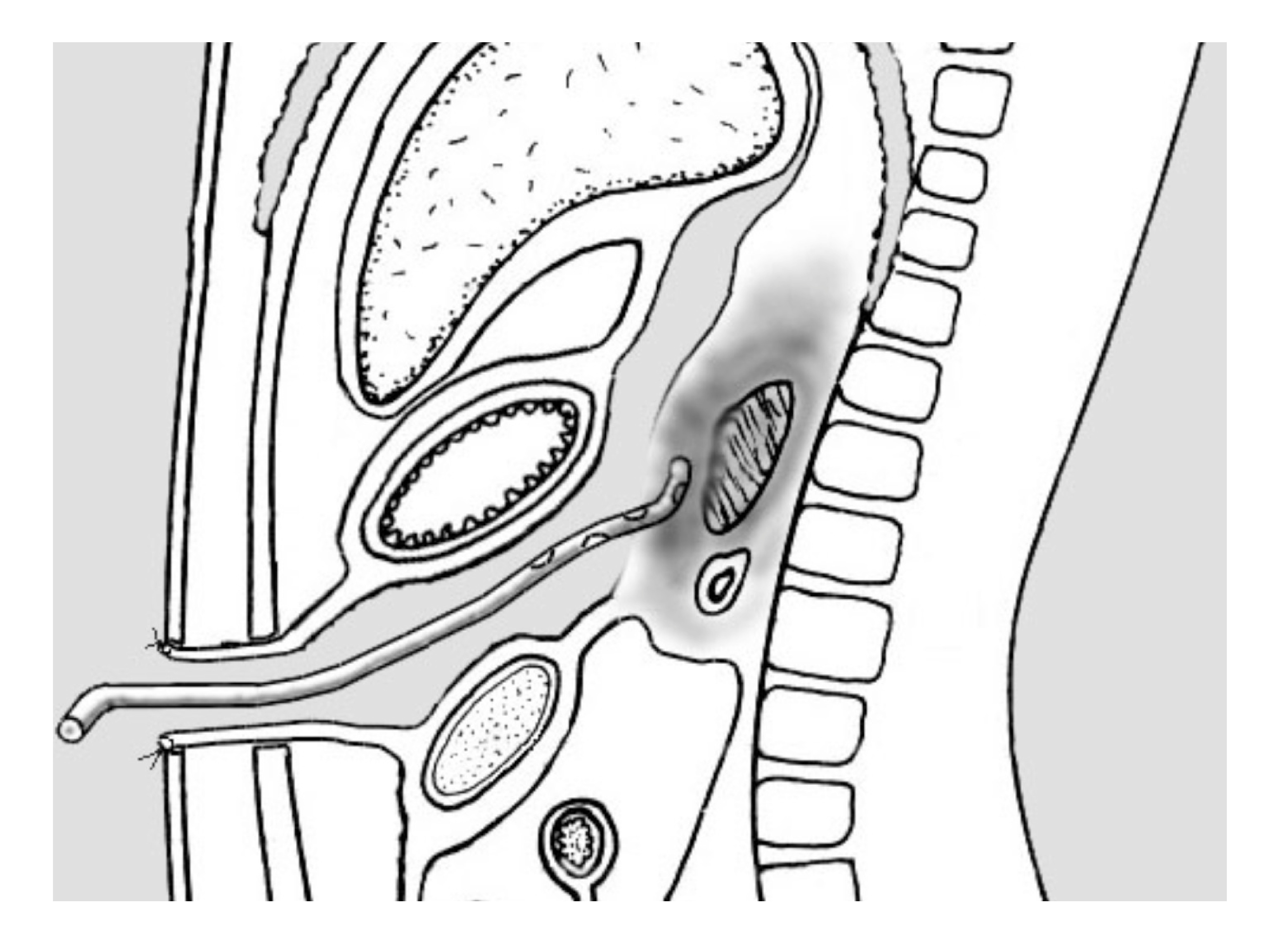 Дренирование абсцесса брюшной полости. Дренирование сальниковой сумки при остром панкреатите. Дренирование сальниковой. Методы дренирования сальниковой сумки. Дренирование сальниковой.