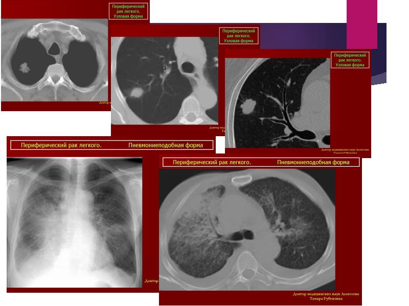 Рак легкого презентация онкология