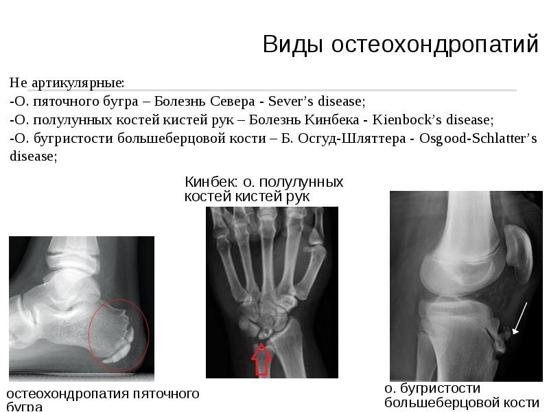 Болезнь кинбека презентация