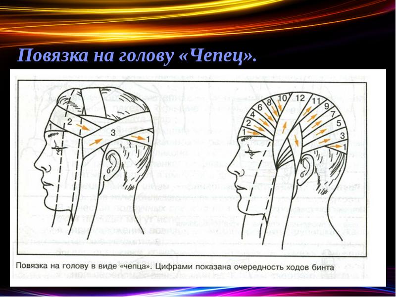 Десмургия виды повязок презентация