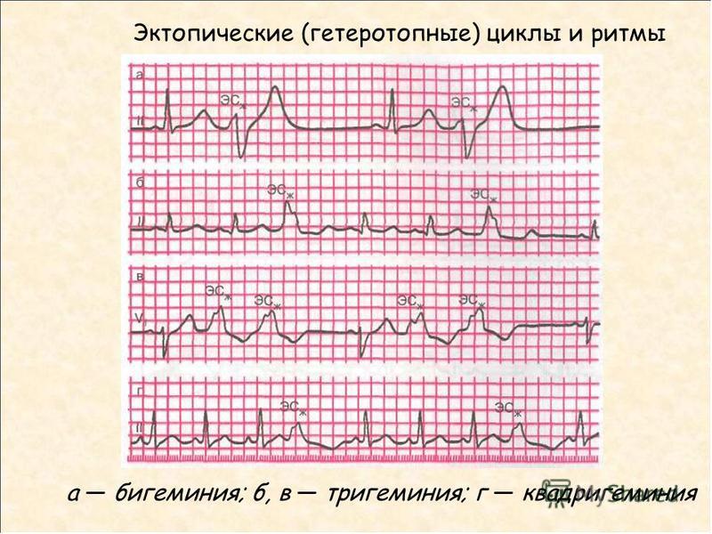 Нарушение ритма по типу бигеминии карта вызова