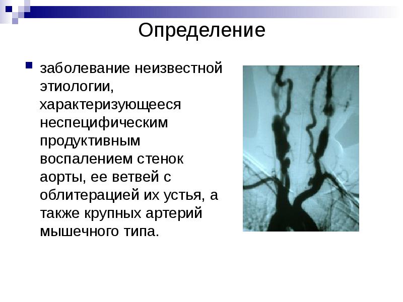 Синдром такаясу презентация