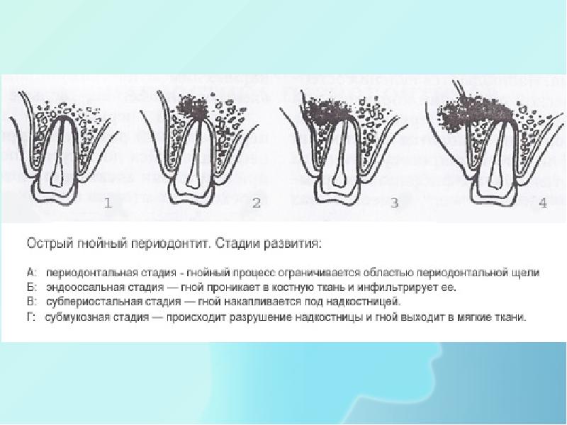 Периодонтит план лечения