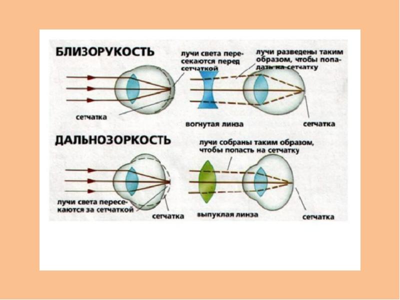 Схема лучей. Схема хода параллельного пучка лучей близорукого глаза. Близорукость ход лучей. При близорукости лучи света фокусируются за сетчаткой. Ход лучей в близоруком глазу.