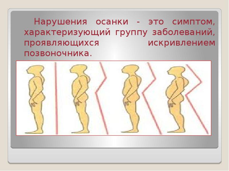 Перечислите нарушения осанки. Заболевания нарушения осанки. Симптомы нарушения осанки. Факторы нарушения осанки и зрения. Изменение осанки человека биология.