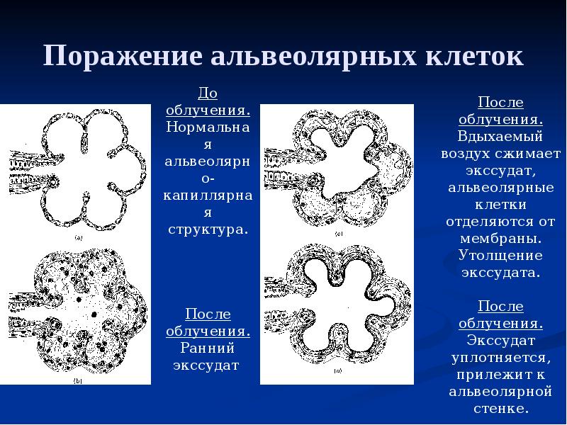 Осложнения лучевой терапии презентация