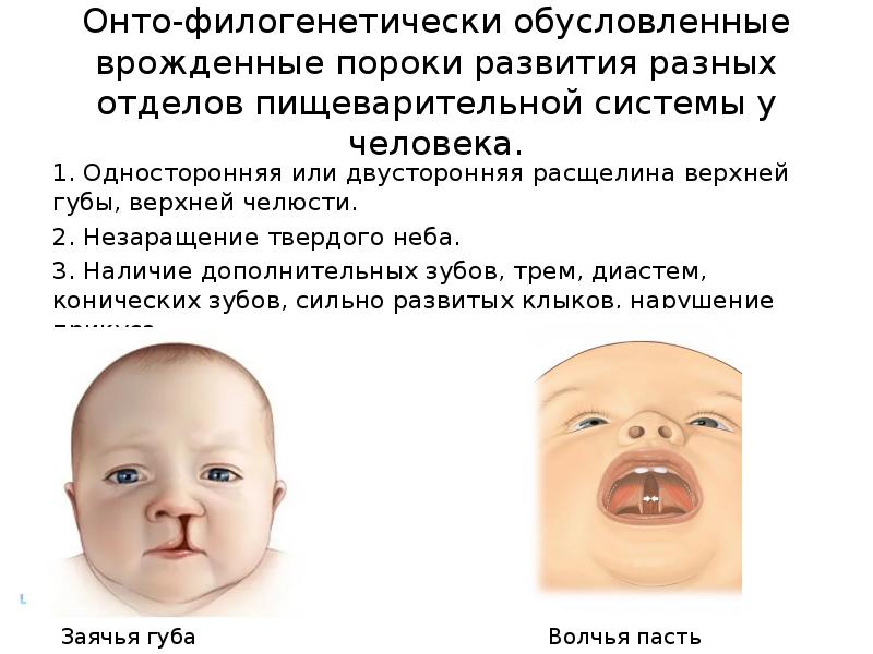 Онто-филогенетически обусловленные врожденные пороки развития разных отделов пищеварительной системы у человека.