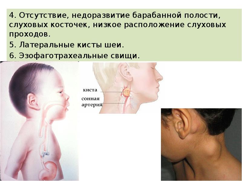 4. Отсутствие, недоразвитие барабанной полости, слуховых кос&shy;точек, низкое расположение слуховых проходов.