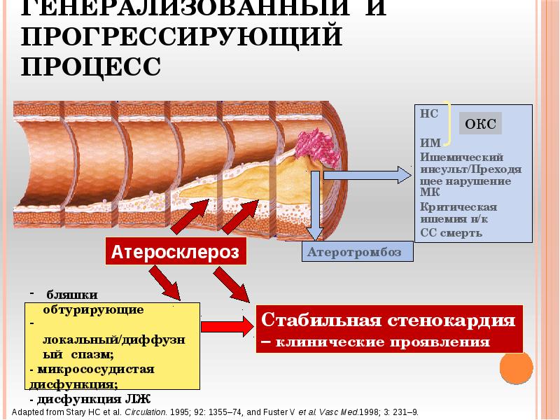 Атеросклероз: генерализованный и прогрессирующий процесс Атеросклероз: генерализованный и прогрессирующий процесс