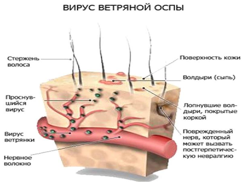 Фото вируса ветряной оспы