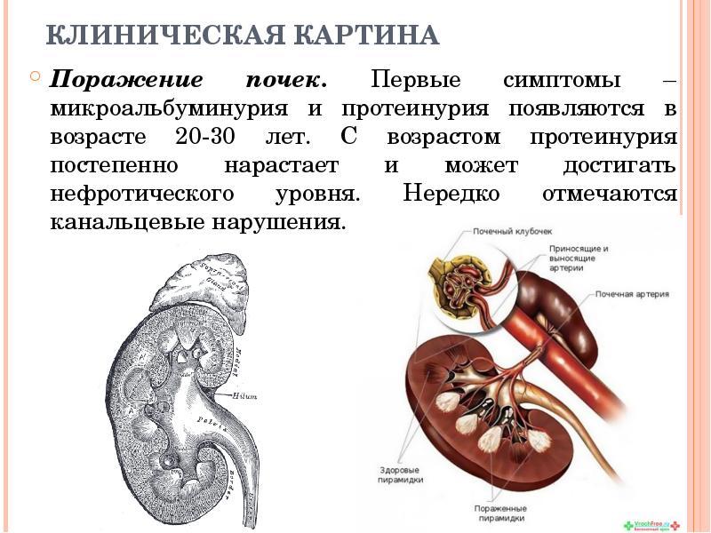 КЛИНИЧЕСКАЯ КАРТИНА Поражение почек. Первые симптомы – микроальбуминурия и протеинурия появляются