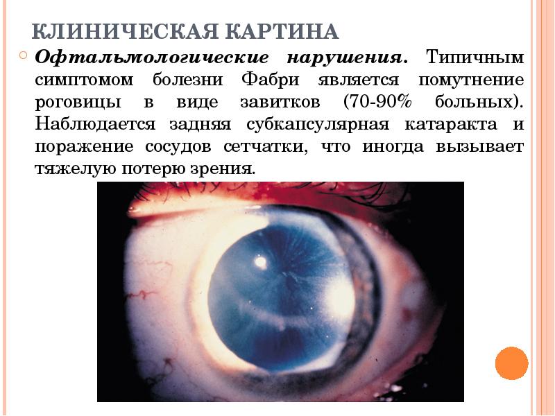 КЛИНИЧЕСКАЯ КАРТИНА Офтальмологические нарушения. Типичным симптомом болезни Фабри является помутнение роговицы