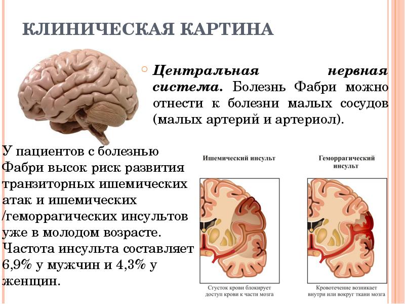 КЛИНИЧЕСКАЯ КАРТИНА Центральная нервная система. Болезнь Фабри можно отнести к болезни