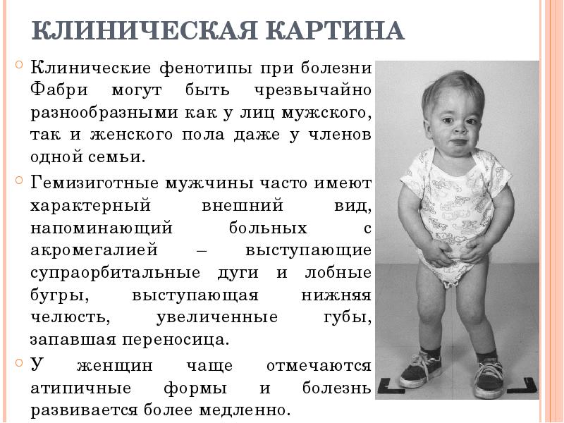 КЛИНИЧЕСКАЯ КАРТИНА Клинические фенотипы при болезни Фабри могут быть чрезвычайно разнообразными