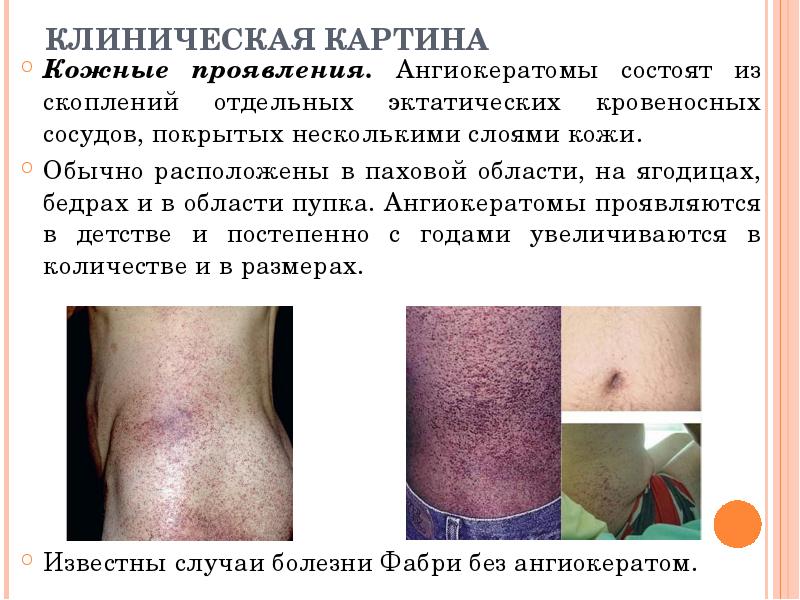 КЛИНИЧЕСКАЯ КАРТИНА Кожные проявления. Ангиокератомы состоят из скоплений отдельных эктатических кровеносных