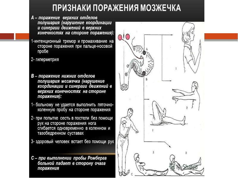 Центральный и периферический паралич презентация