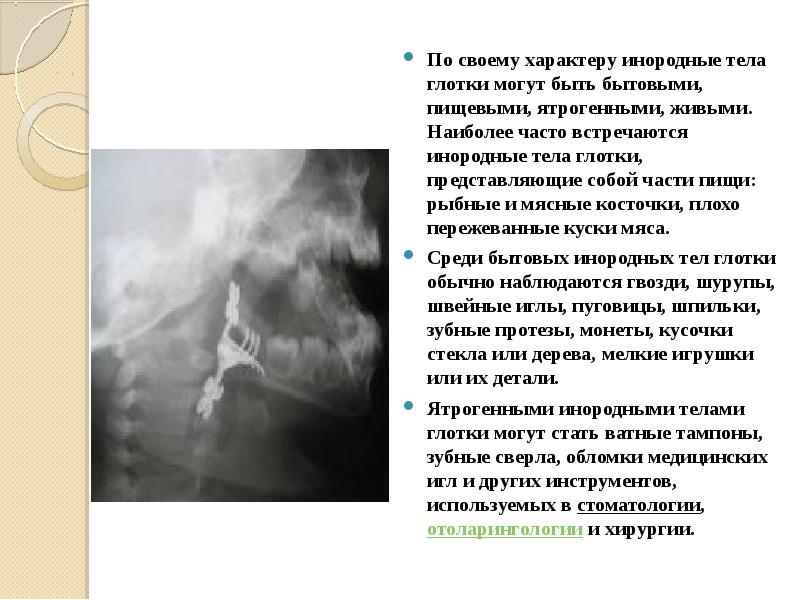 Презентация инородные тела глотки