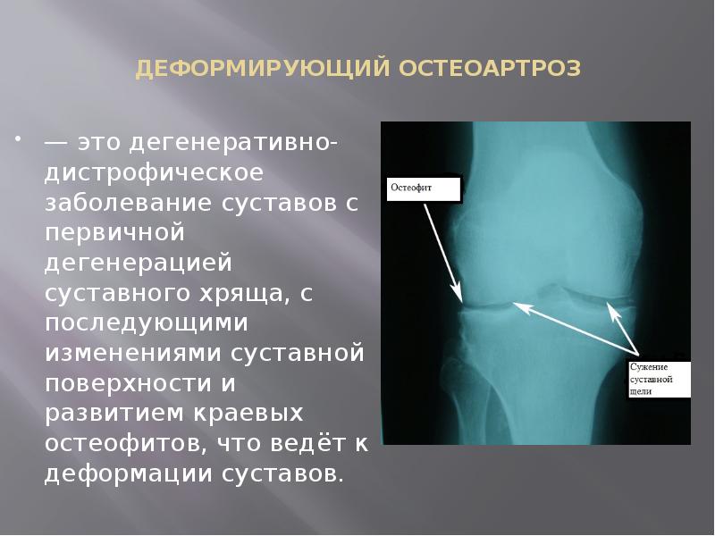 ДЕФОРМИРУЮЩИЙ ОСТЕОАРТРОЗ  — это дегенеративно-дистрофическое заболевание суставов с первичной дегенерацией